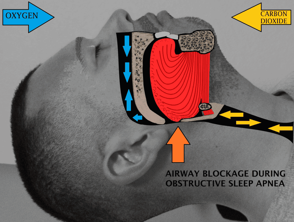 Obstructive sleep apnea can cause airway blockages during sleep.