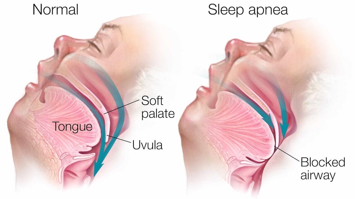 Obstructive sleep apnea - adults: MedlinePlus Medical Encyclopedia